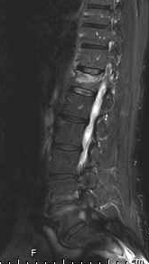 Fracture ancienne de T12 avec hypersignal sur l'IRM