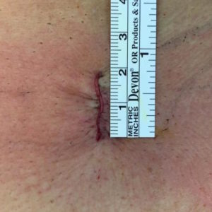 Incision Microdiscectomie 18 mm (Images Dr Rigal)